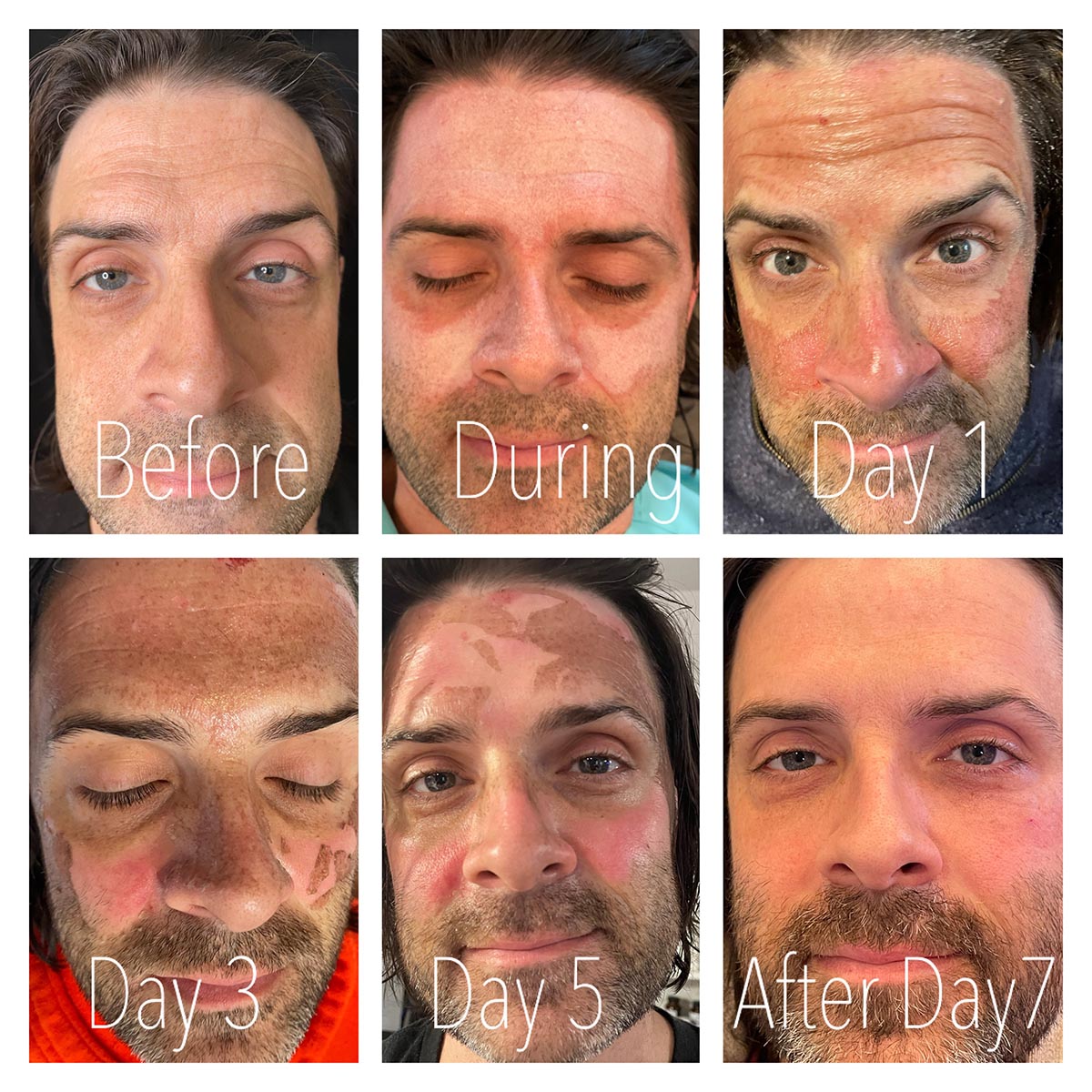 MD Peel Before and After