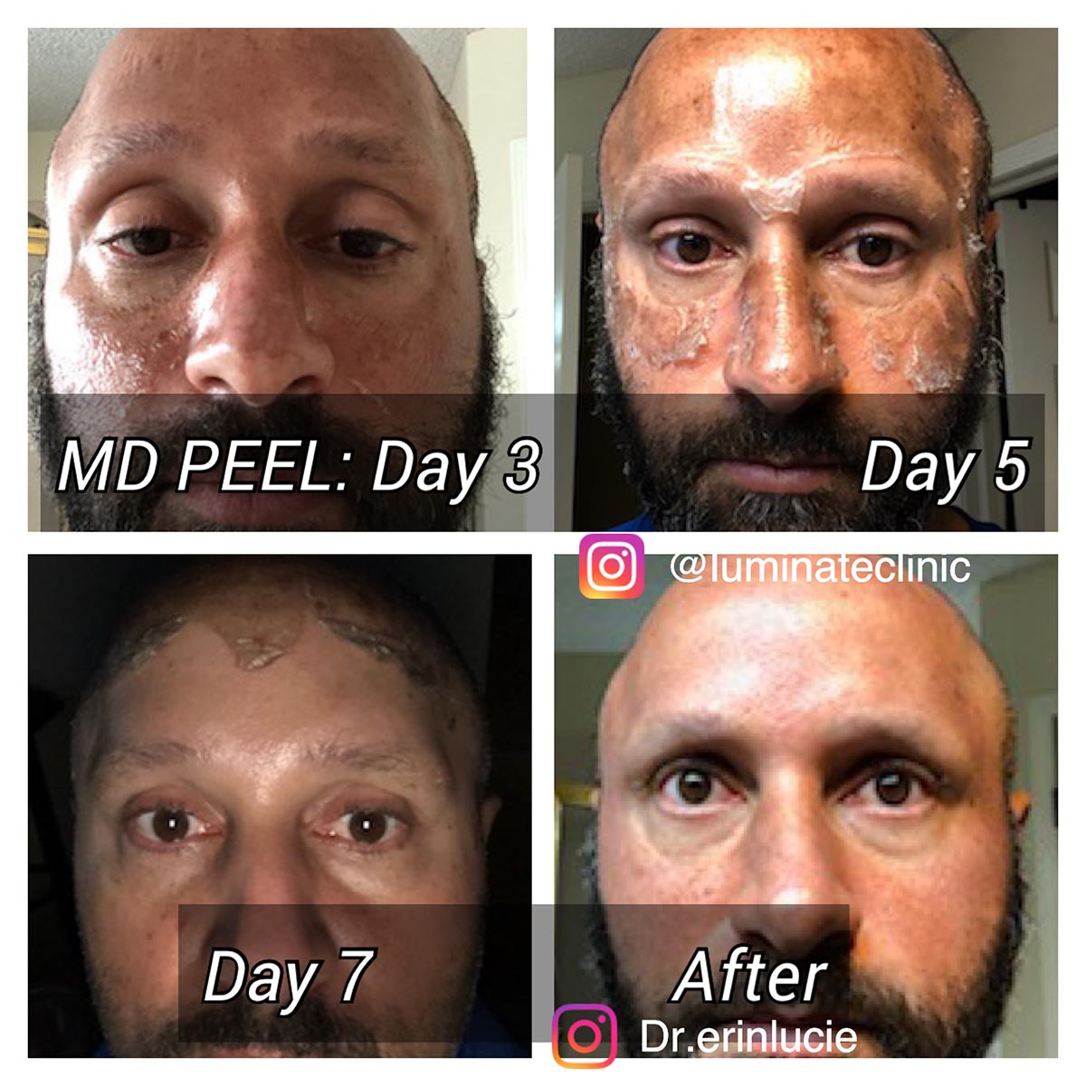 MD Peel Results