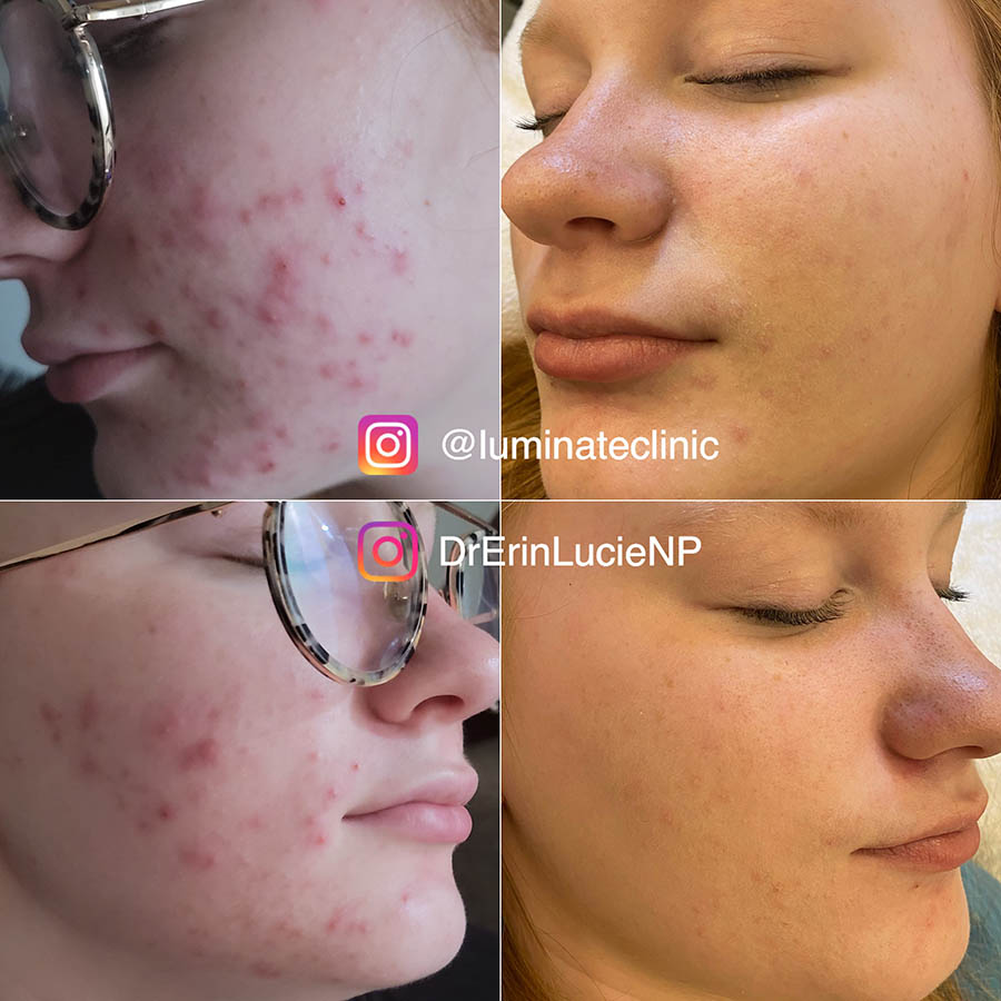 Microneedling Total Skin Rejuvenation Before and After
