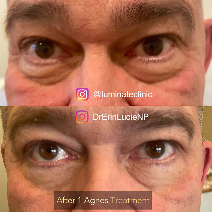 Agnes Treatment Before and After