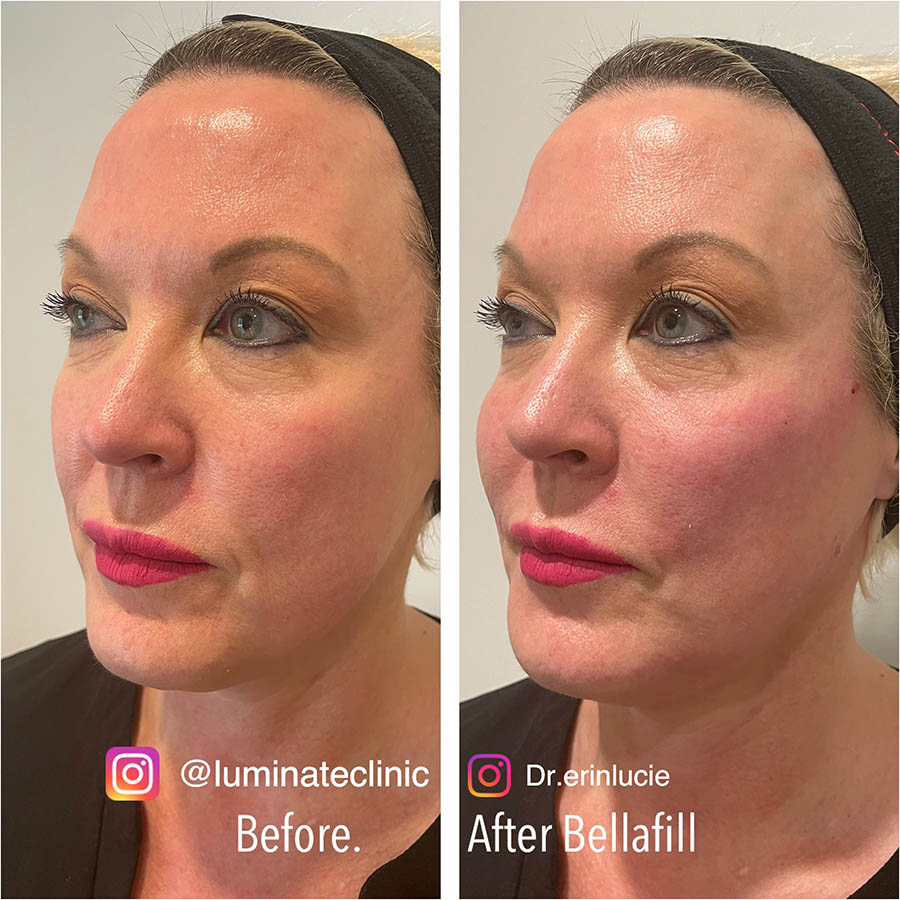 Bellafill PMMA Derma Fillers Before and After