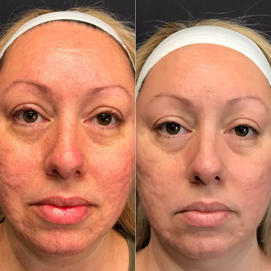 Scarlet SRF Anti Aging Skin Rejuvenation Before and After