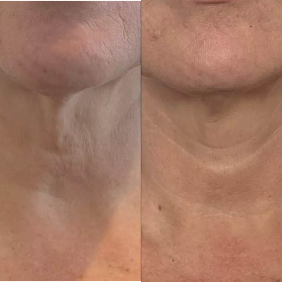 Scarlet SRF Skin Rejuvenation Before and After