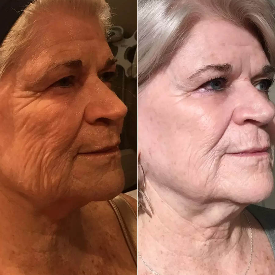 Before and After Scarlet SRF Anti Aging