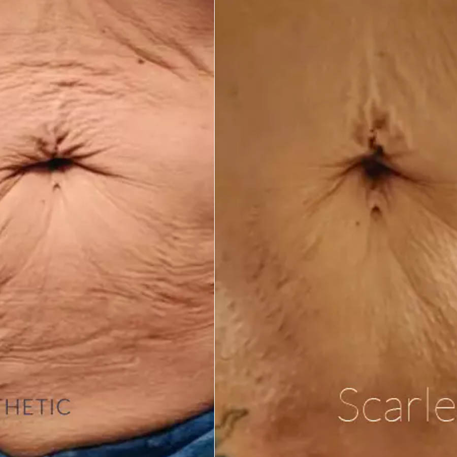 Scarlet SRF Anti Aging Before and After
